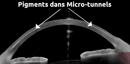 Keratopigmentation technique